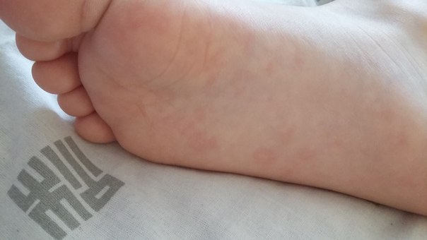 Аллергия в области пятки