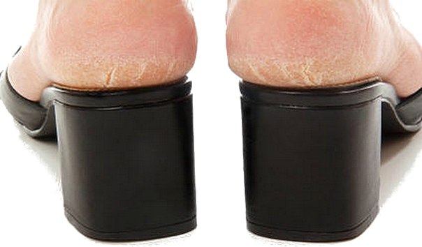 Почему лопаются пятки на ногах у женщин лечение в домашних thumbnail