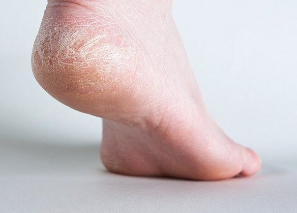 Почему сухая кожа ног и пятки thumbnail