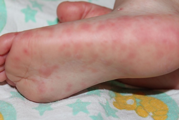 Возможная Аллергия на пятках у ребенка
