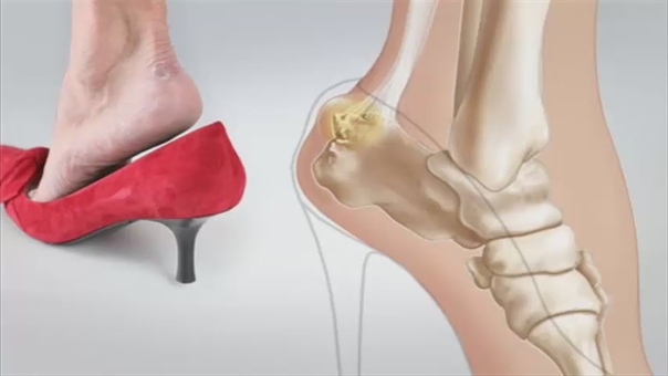Почему болят пятки ног лечение народными средствами thumbnail