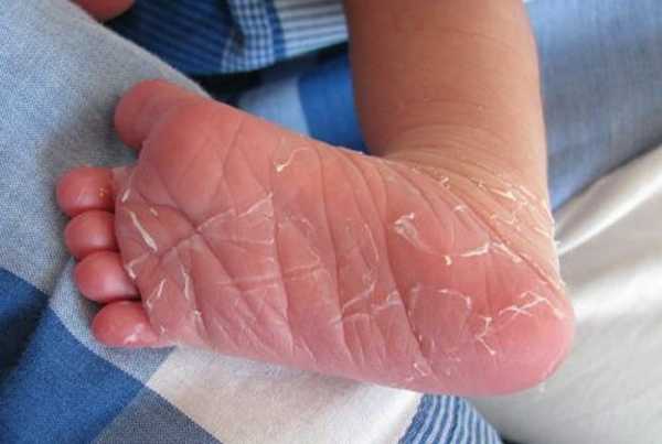 Причины шелушащихся пяток у детей. Способы избавления от шелушения кожи